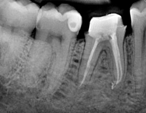 dente curato endodonzia