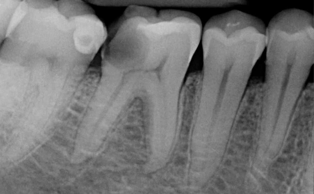 endodonzia dei denti prima