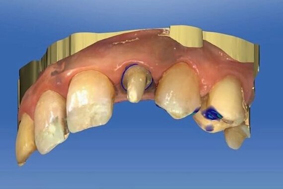 Protesi Cad/Cam con Impronta Ottica