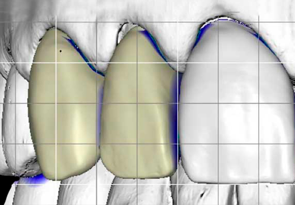 Protesi dentale Cad Cam con impronta ottica